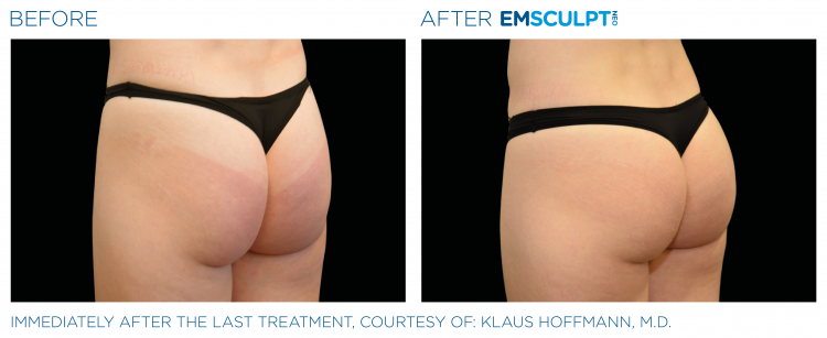 EMSCULPT NEO Before & After | Body Sculpting