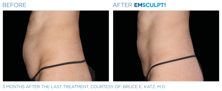 EMSCULPT NEO Before & After | Body Sculpting