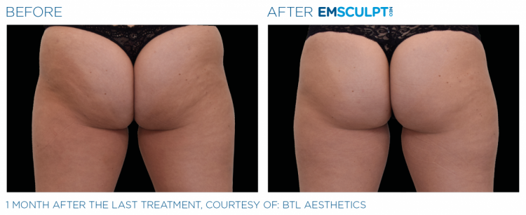 EMSCULPT NEO Before & After | Body Sculpting