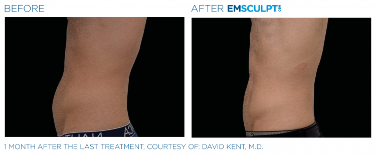 EMSCULPT NEO Before & After | Body Sculpting