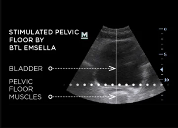 After EMSELLA Treatment | Pelvic Floor Strengthening