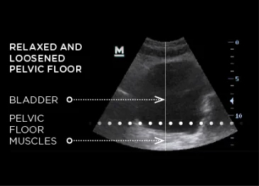 Before EMSELLA Treatment | Pelvic Floor Strengthening